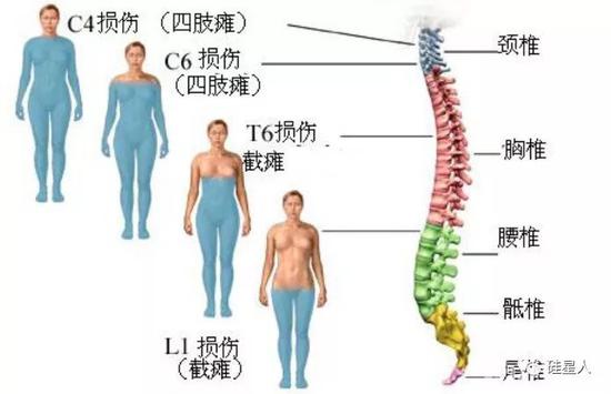 脊柱里的小电脑或许能让千万瘫痪者重新站起来